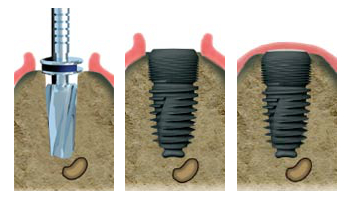 Spécialiste implant dentaire Schiltigheim