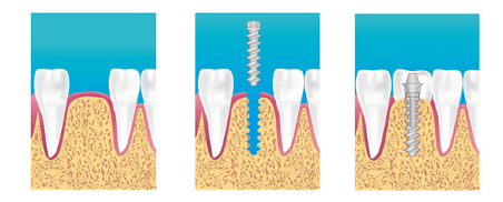 Implants dentaires Schiltigheim